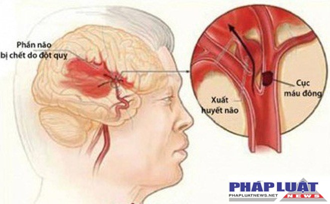 Đột quỵ não: Cần xử trí sớm và đúng cách